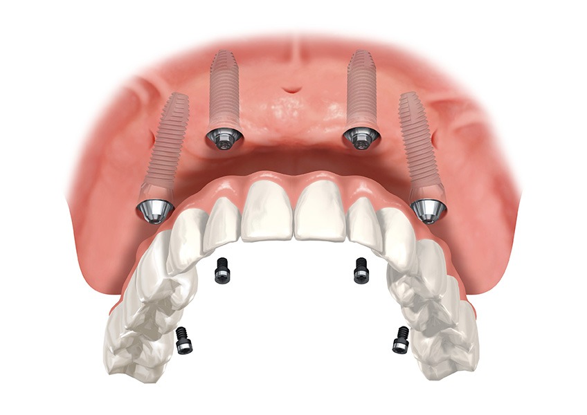 implant-supported dentures near you